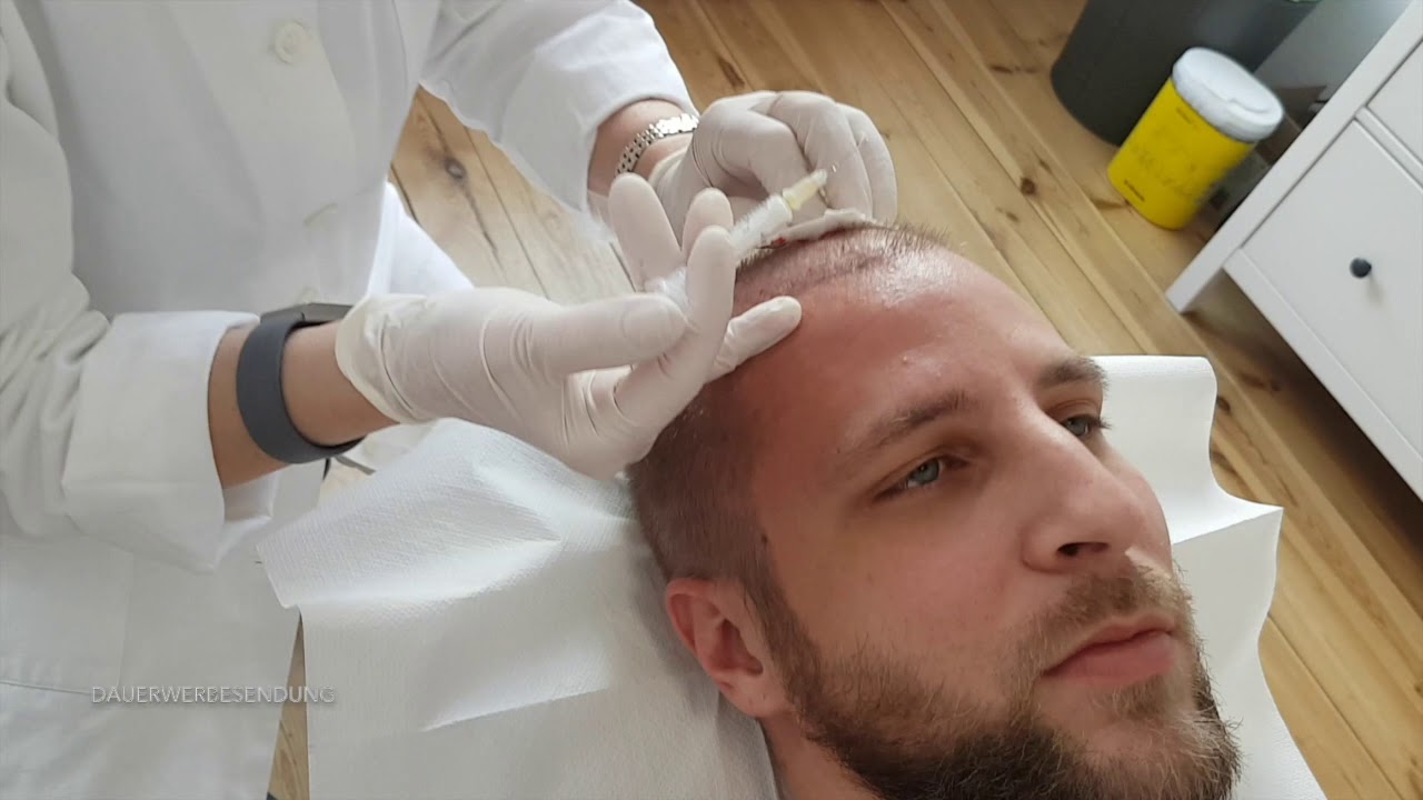Vampir Lift Berlin: Faltenreduktion und Haarrevitalisierung mit der innovativen PRP-Therapie bei Dr. Jungk