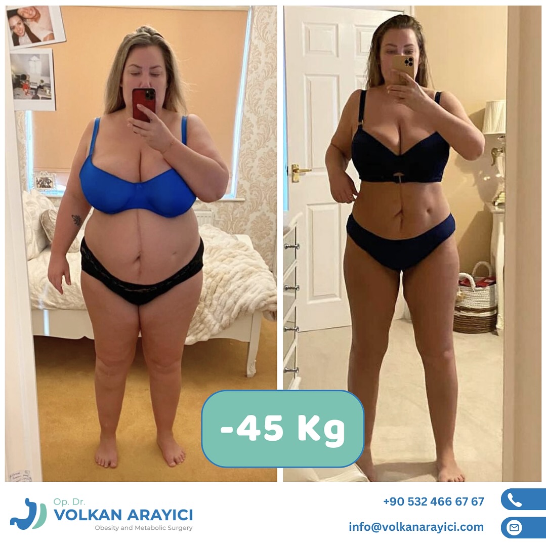 Preischeck Bypass-OP – wie viel kostet eine magenverkleinerung in Kombination mit Bypass?